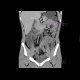 Crohn's disease, intra-abdominal abscess, enterography: CT - Computed tomography